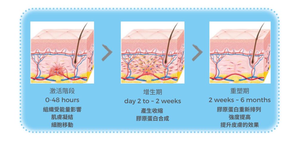 組織受能量影響 肌膚凝結 細胞移動激活階段 0-48 hours產生收縮 膠原蛋白合成增生期 day 2 to ~ 2 weeks膠原蛋白重新排列 強度提高 提升皮膚的效果重塑期 2 weeks ~ 6 months