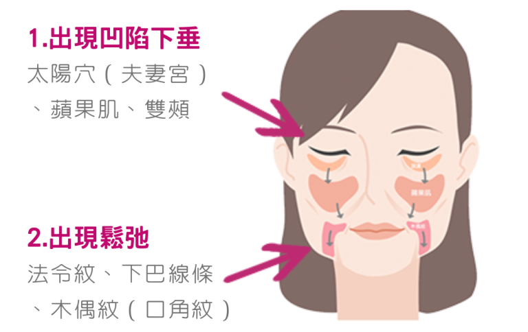 TINGHOUSE Aesthefill 童顏精靈針1.太陽⽳（夫妻宮）、蘋果肌、雙頰、出現凹陷下垂 2.法令紋、⽊偶紋（⼝⾓紋）下巴線條及臉部⽪膚的鬆弛下垂都能改善