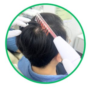 高頻電流殺菌梳 高頻電波和紫外線來抑制頭皮上的細菌和減少毛囊發炎 功效： 殺滅頭皮細菌 改善發炎問題,如毛囊炎、頭瘡等