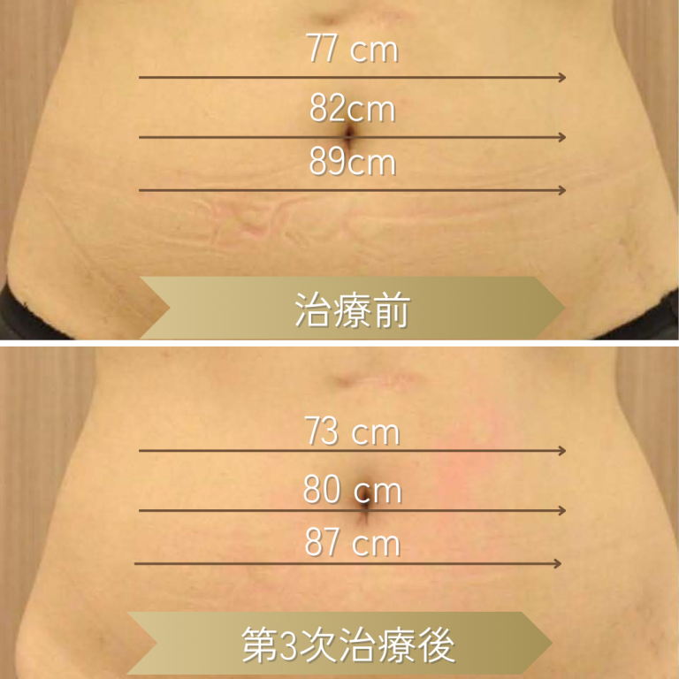 New Doublo 減少腹部脂肪